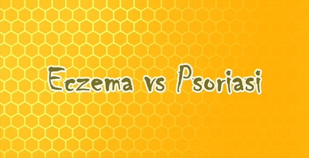 Eczema o Psoriasi come riconoscerle e consigli per gestirle