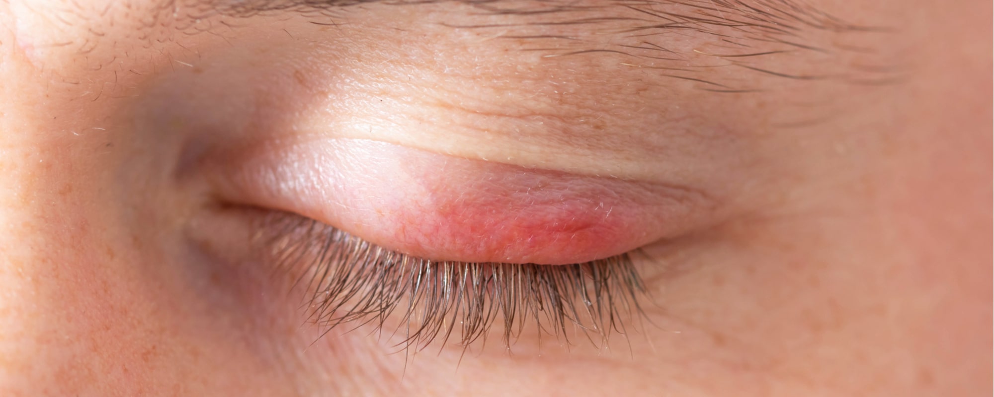 Eczema sulle palpebre: 5 modi per trattarlo in modo naturale